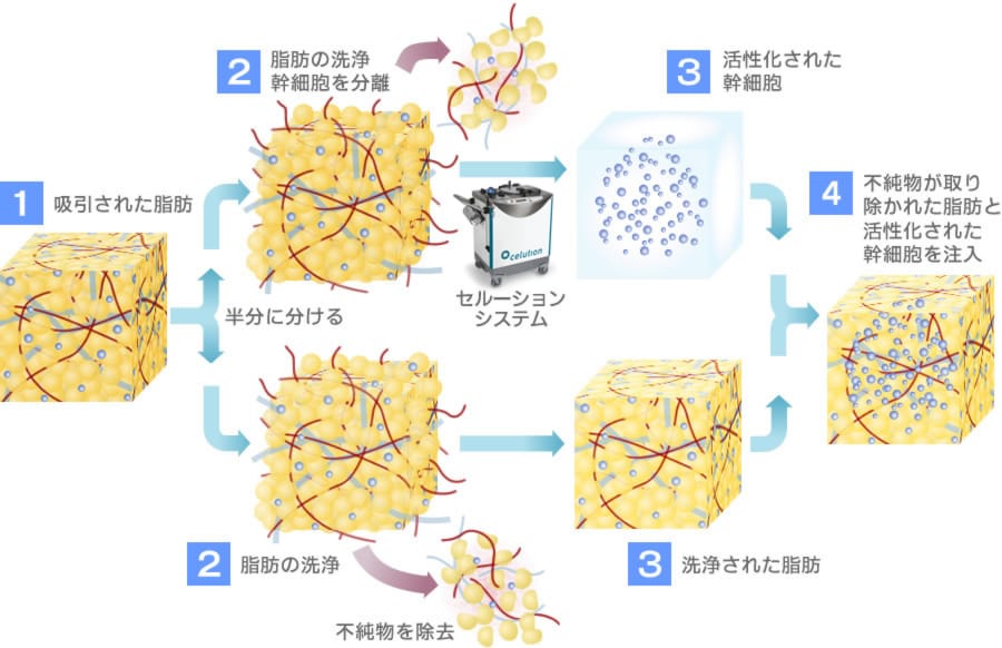 セルーション豊胸