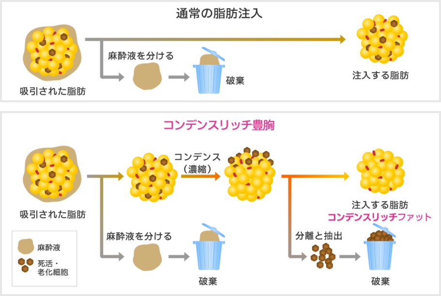 コンデンスリッチ豊胸