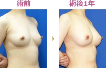 ライポマティック併用リジェネラ併用セルーション豊胸 術前 術後1年 その1