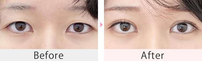 全切開法二重術