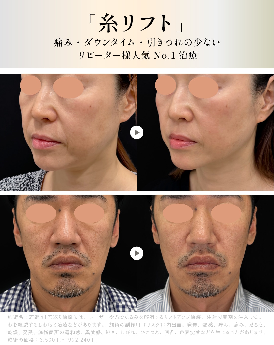 糸リフト
