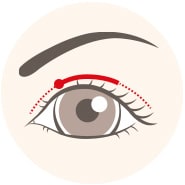 腫れづらいスクエア二重術