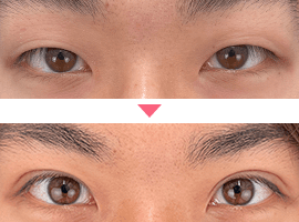 男性二重・目元整形症例写真2