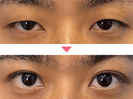男性二重・目元整形症例写真3