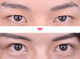 男性二重・目元整形症例写真4