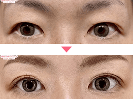 40代以上女性二重・目元整形症例写真1