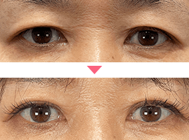 40代以上女性二重・目元整形症例写真4