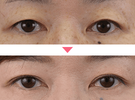 40代以上女性二重・目元整形症例写真5