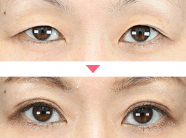 40代以上女性二重・目元整形症例写真7