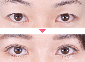 40代以上女性二重・目元整形症例写真8