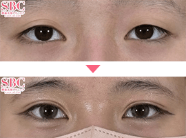 10代女性二重・目元整形症例写真2