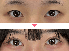 10代女性二重・目元整形症例写真3