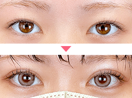 10代女性二重・目元整形症例写真4