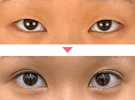 10代女性二重・目元整形症例写真5