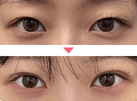 20代～30代女性二重・目元整形症例写真1