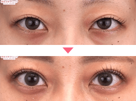 20代～30代女性二重・目元整形症例写真3