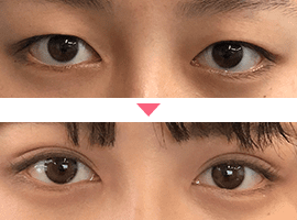 20代～30代女性二重・目元整形症例写真4