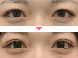 20代～30代女性二重・目元整形症例写真5