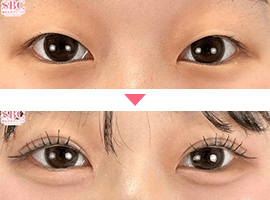20代～30代女性二重・目元整形症例写真6