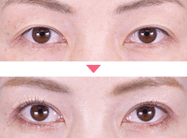 20代～30代女性二重・目元整形症例写真7
