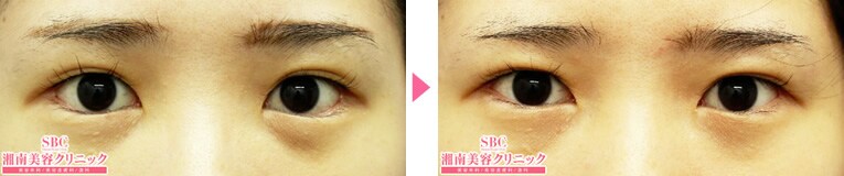 二重 目元整形なら湘南美容クリニック 公式 美容整形 美容外科 二重 目元整形なら湘南美容クリニック 公式 美容整形 美容外科