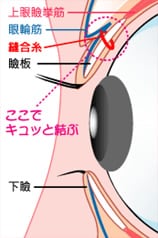 片目に留める糸の場所ー瞼板