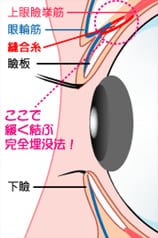 片目に留める糸の場所ー挙筋