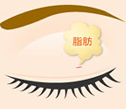 マイクロリポサクション法 二重 目元整形なら湘南美容クリニック 公式