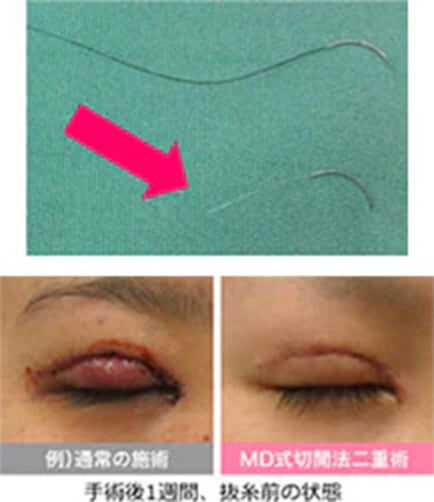 縫合には透明な糸を使用
