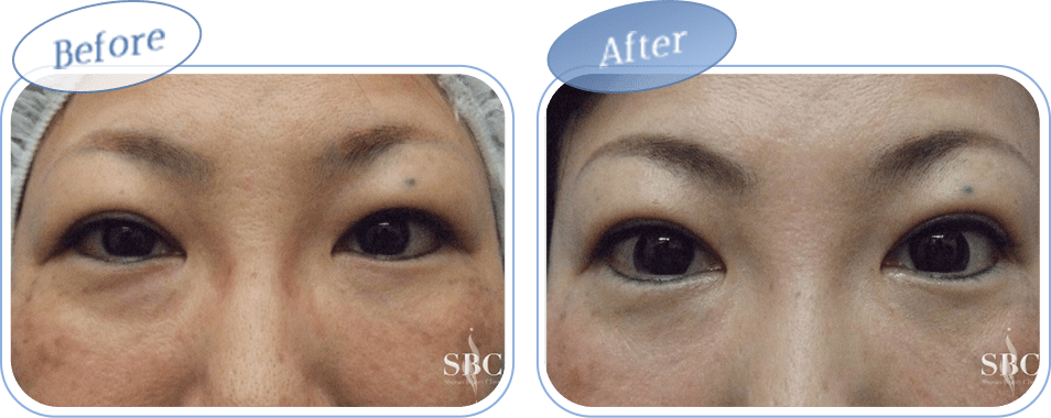 before after