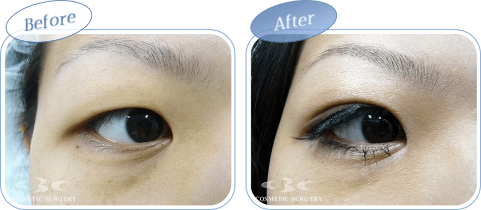 before after