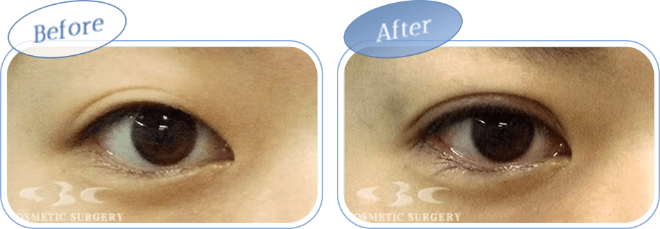 before after