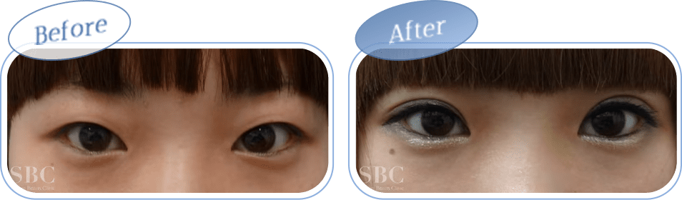 before after