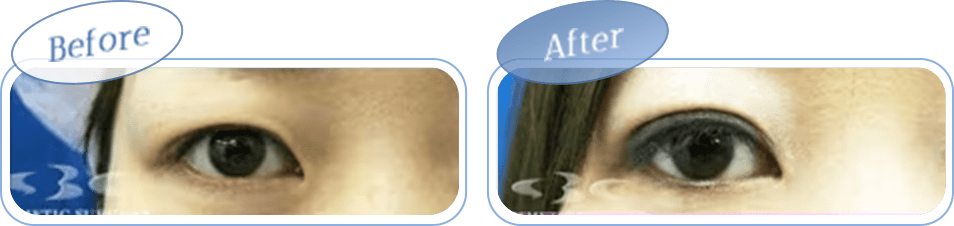 before after