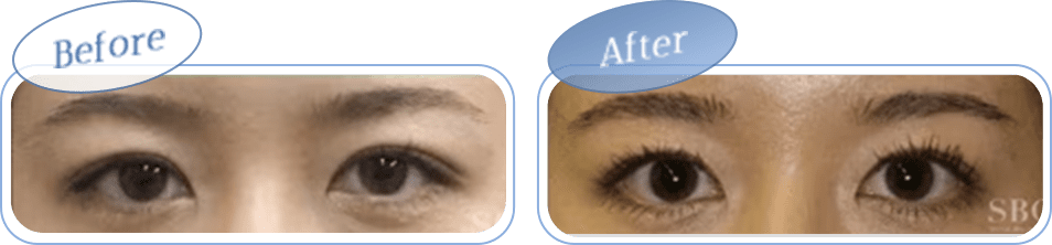 before after