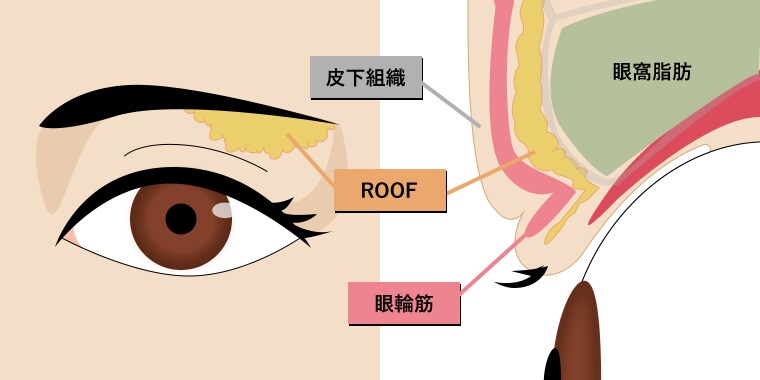 まぶたの脂肪