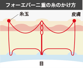 フォーエバー二重術®の糸のかけ方