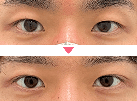 男性二重・目元整形症例写真1