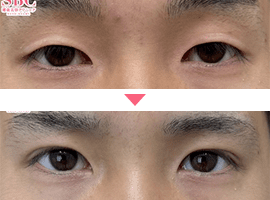 男性二重・目元整形症例写真2