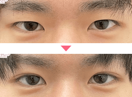 男性二重・目元整形症例写真3