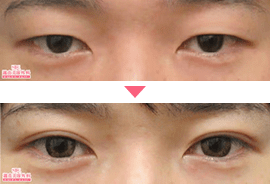 男性二重・目元整形症例写真4
