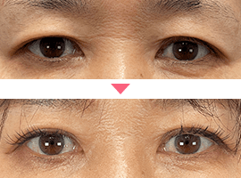 40代以上女性二重・目元整形症例写真2
