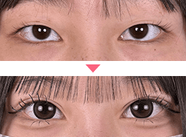 10代女性二重・目元整形症例写真1