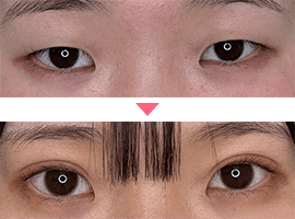10代女性二重・目元整形症例写真2