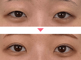 10代女性二重・目元整形症例写真3
