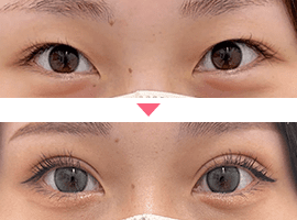 20代~30代女性二重・目元整形症例写真1