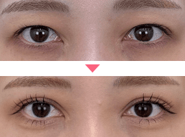 20代~30代女性二重・目元整形症例写真2