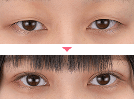 20代~30代女性二重・目元整形症例写真3