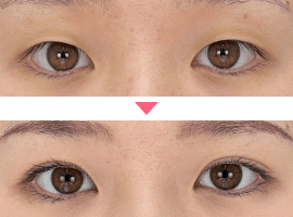 20代~30代女性二重・目元整形症例写真4
