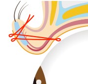 切らない眼瞼下垂 真崎式 イメージ